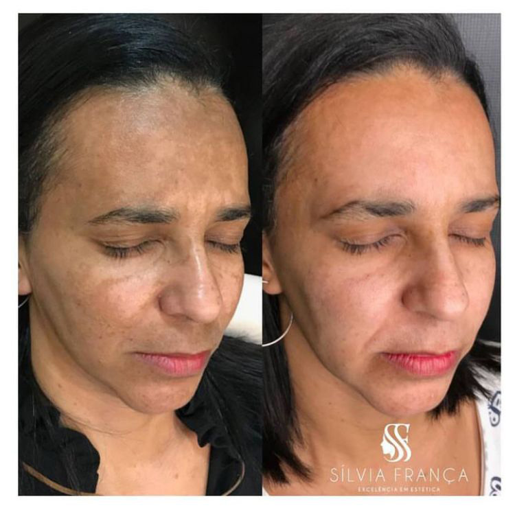 Resultado de tratamento de melasma — Sílvia França