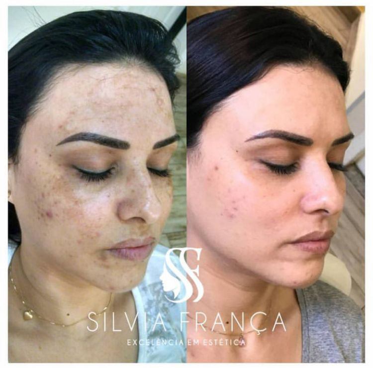 Resultado de tratamento de melasma — Sílvia França