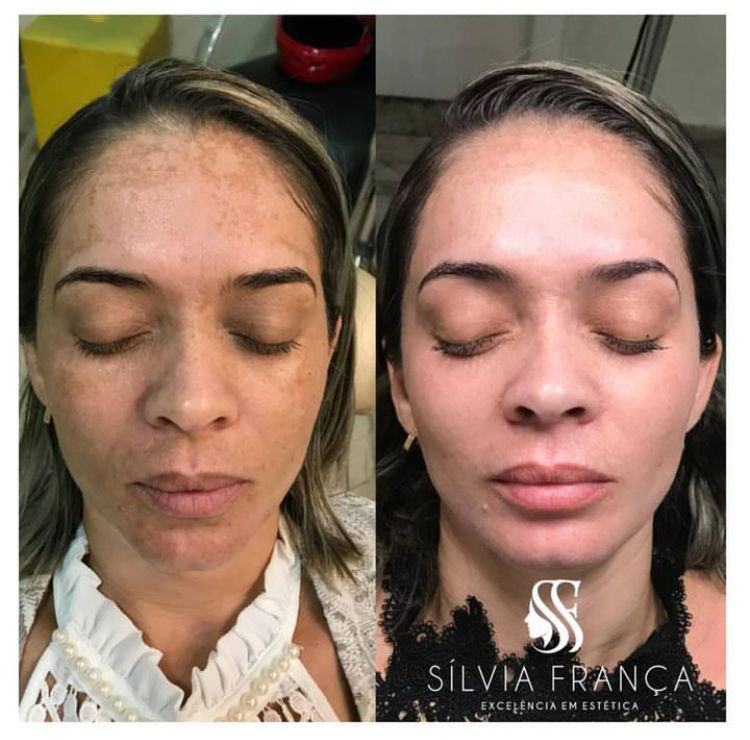Resultado de tratamento de pele — Sílvia França