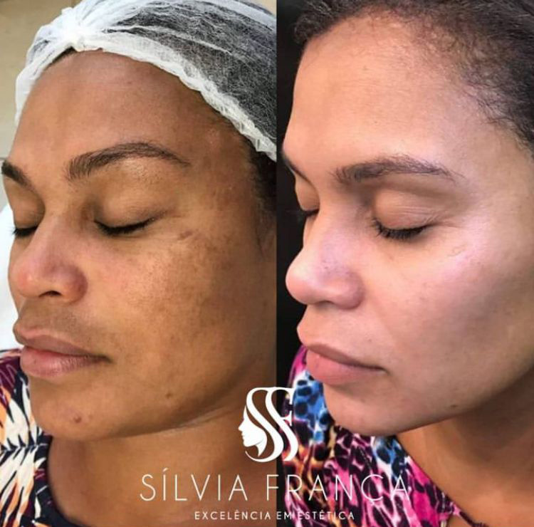 Resultado de tratamento de pele — Sílvia França