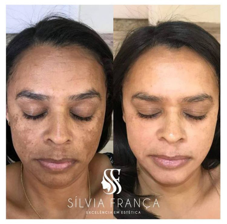 Resultado de tratamento de melasma — Sílvia França
