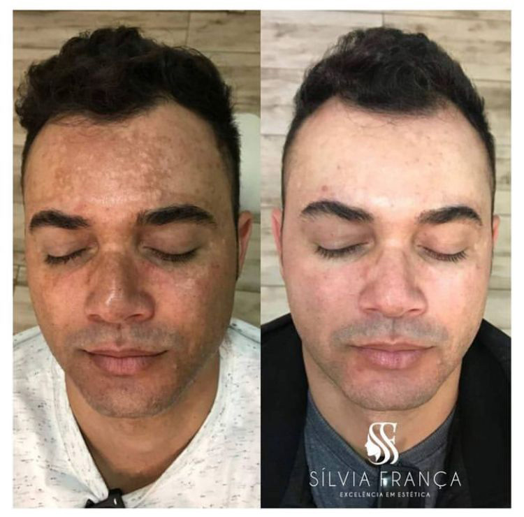 Resultado de tratamento de pele — Sílvia França