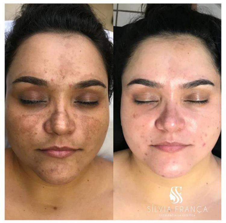 Resultado de tratamento de melasma — Sílvia França