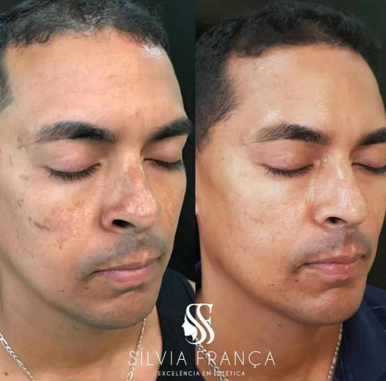 Resultado de tratamento de pele — Sílvia França