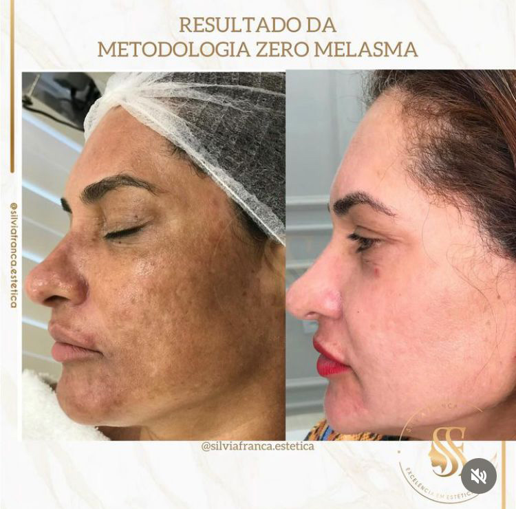 Resultado de tratamento de melasma — Sílvia França